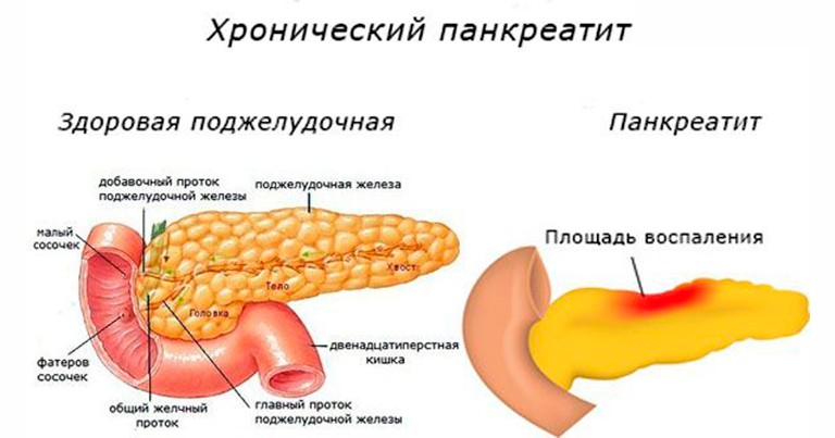 Хронический панкреатит картинки для презентации