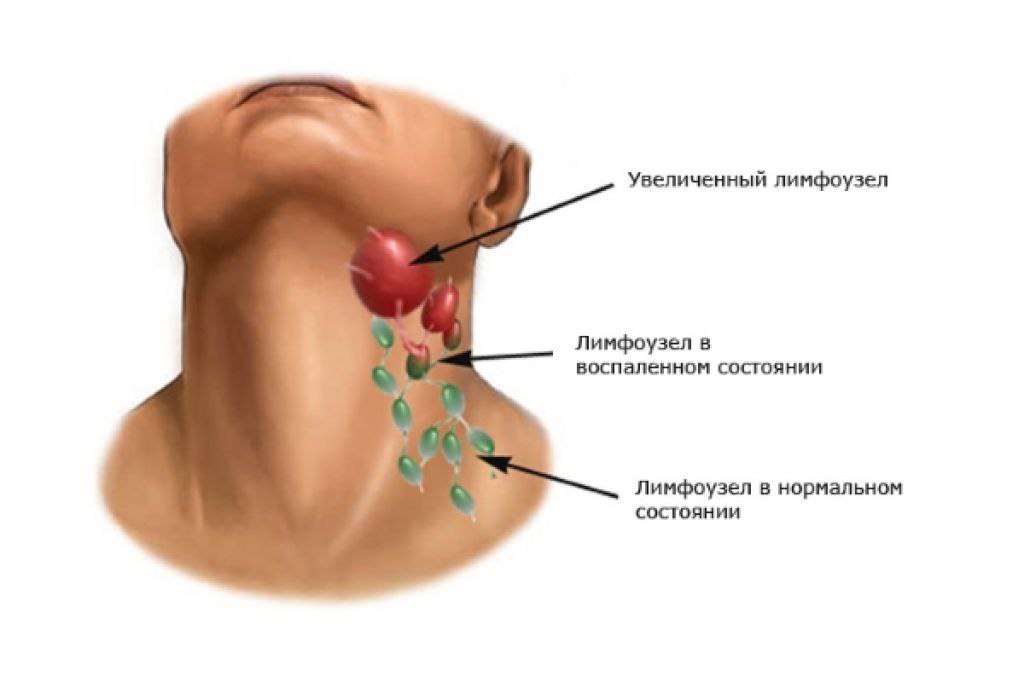 Миндалины и лимфоузлы на шее схема