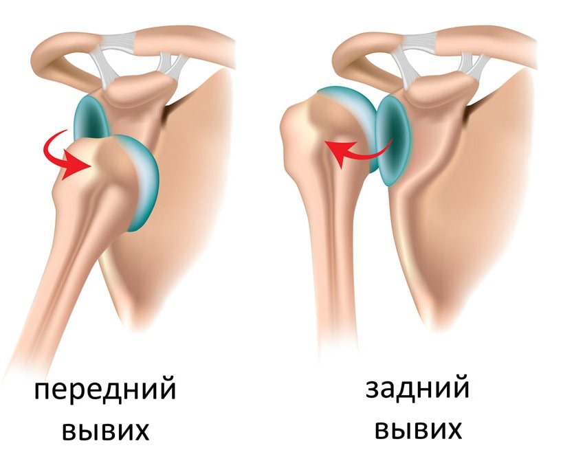 Картинка вывиха сустава