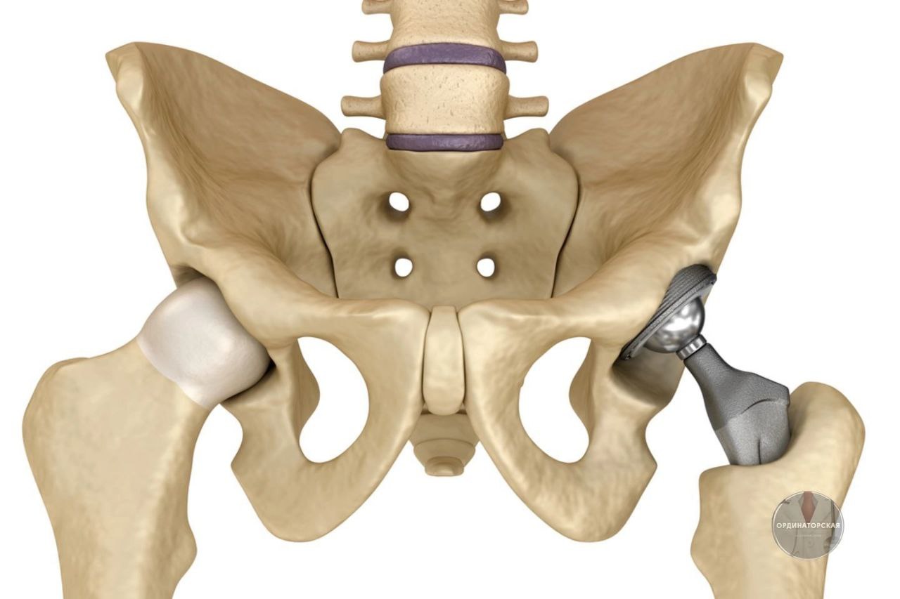 Тазобедренный протез фото